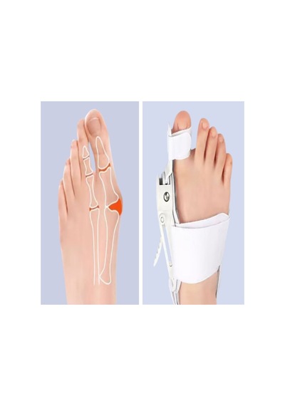 Ayarlanabilir Ayak Baş Parmak Kemik Düzeltici - Halluks Valgus Bunyon Aparatı