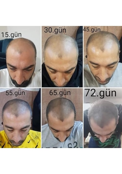 Ayrex Dermanew Saç Büyüme Serumu, Hair, 50 Ml, 10'lü Set - Hair