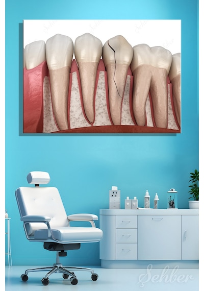 Diş Eti Çene Kemiği Dikey Çatlak Diş Krack Diş 3d Tıbbi İllüstrasyon Kanvas Tablo Yatay Tekli 3669