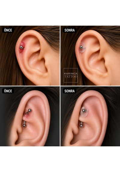 Piercing Keloid Diski Bump Piercing Yara Önleyici Bioplast 10 Adet çok renkli