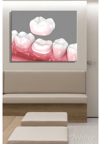 Diş Tacı Yerleşimi Diş Kronunu 3d Tıbbi İllüstrasyon Tekli Kanvas Tablo Yatay 3588