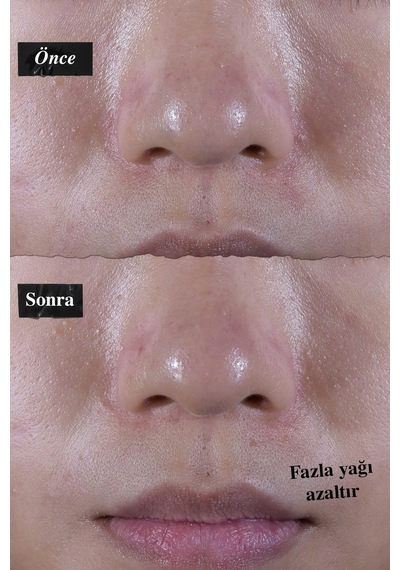 Yağlı Ve Normal Ciltler İçin Parlamayı Azaltan, Ferahlatıcı Ve Nemlendirici Jel Krem 28 Ml