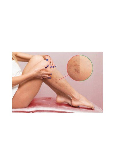 Spıder Veins Defense Cream Selülit Diz 120 Ml X 2 Adet