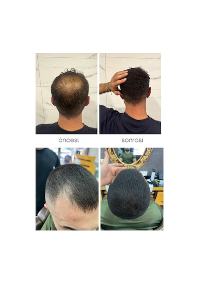 Seyrek Saç Kapatıcı Kalıcı Losyon - Saç Kapatıcı Dolgunlaştırıcı Sıvı Krem Anında Hacimli Doğal Görünüm 50ml X 2 Adet
