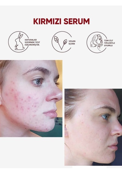 Nedox Cilt Yenileyici Cilt Tonu Eşitleyici Kırmızı Peeling Serum 30 ML