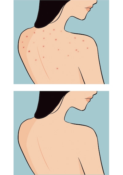 Skin Sensual Buttoks Buttne Vücut Maskesi | Vücut Sivilceleri ve Pürüzlere Karşı | 2 Parça