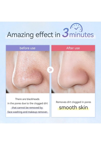 Anlan Ultrasonik Peeling Cilt Temizleyici Beyaz
