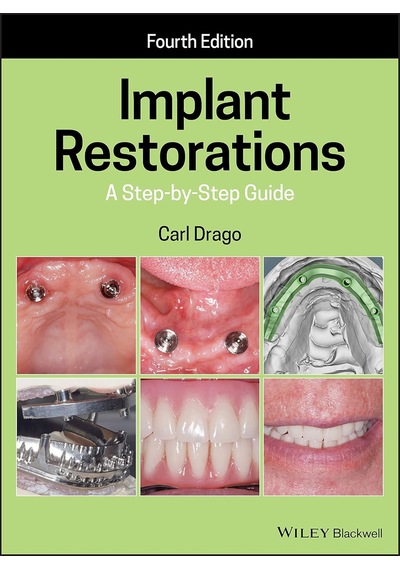 .atfredesignv2 .collapsed Expandtitletoggle Background-image: Url "" Top: 1.4rem Right: 0rem .atfredesignv2 .expanded Expandtitletoggle Background-image: Url "" Bottom: 1rem Right: 1.6rem Implant Restorations: A Step By Step Guide