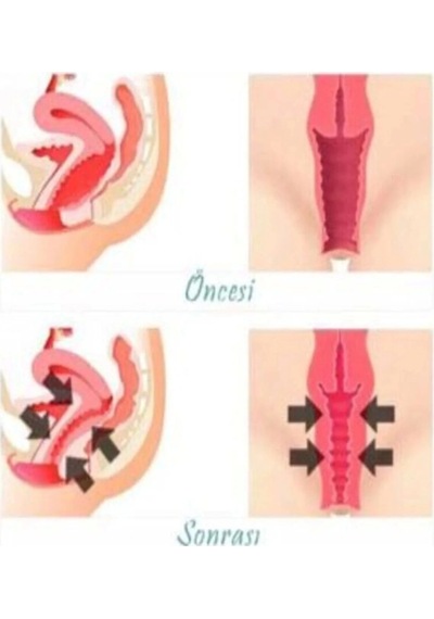 Süper Vagitight Kadınlara Özel Genital Bölge Krem 100 Ml X 3 Adet