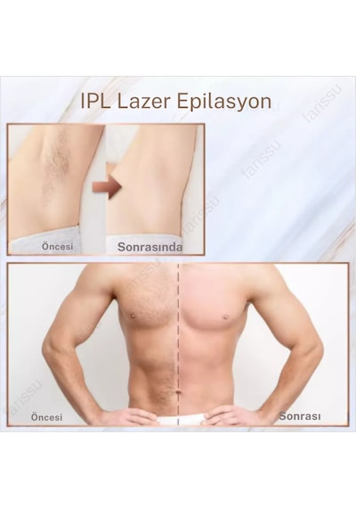 Trend Farma Soğuk Buz İpl Lazer Epilasyon Cihazı - 999.999 Atım, Ağrısız Buz Lazer