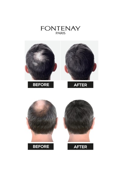 Fontenay Saç Dolgunlaştırıcı Keratin Fibers Orta Kahve Topik Saç Tozu 50gr + Saç Spreyi 2'li Set