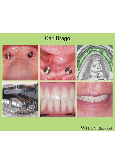 .atfredesignv2 .collapsed Expandtitletoggle Background-image: Url "" Top: 1.4rem Right: 0rem .atfredesignv2 .expanded Expandtitletoggle Background-image: Url "" Bottom: 1rem Right: 1.6rem Implant Restorations: A Step By Step Guide