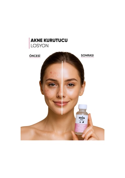 Mia Klinika Akne Karşıtı Losyon 30 ML