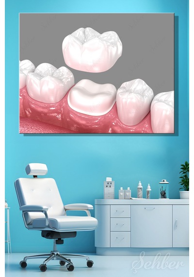 Diş Tacı Yerleşimi Diş Kronunu 3d Tıbbi İllüstrasyon Tekli Kanvas Tablo Yatay 3588