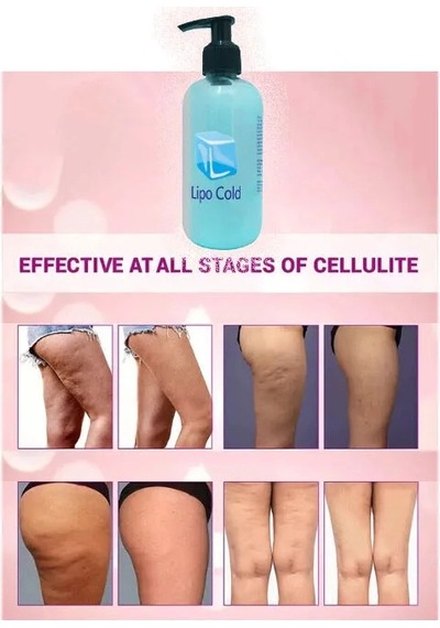 Lipo Cold Karşı Bakım Kremi 250 Ml X 2 Adet