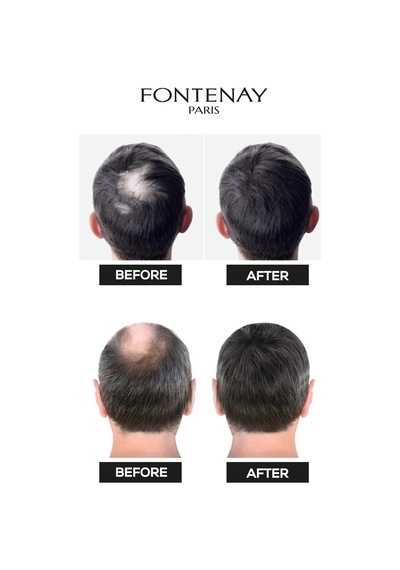 Saç Dolgunlaştırıcı Keratin Fibers Açık Kahve Topik Saç Tozu 50gr + Saç Spreyi 400ml 2'li S Renkli