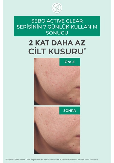 Akne Ve Siyah Nokta Görünümünü Azaltan Nemlendirici Krem Matlaştırıcı Etkili Cilt Bakımı 40 Ml