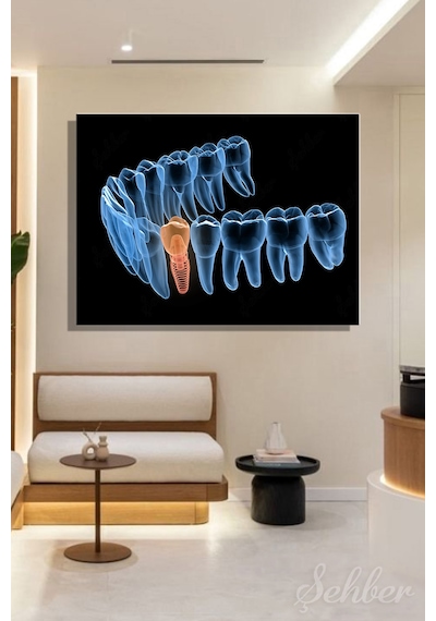Premolor Dişin İmplant Tedavisi 3d Tıbbi Çizim Yatay Kanvas Tablo Tekli Ağız Diş Sağlığı 3480
