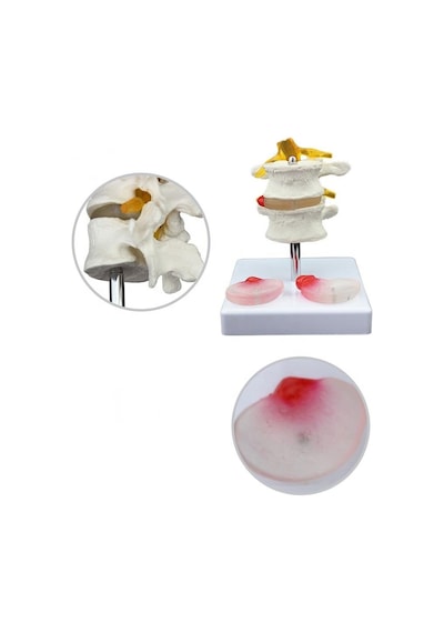 Lumbar Vertebra Disk Hernisi Omurga Modeli Model 4