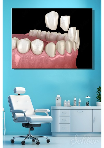 Diş Kaplama Veneer Uygulaması Sürecinin 3 D Aşamaları Tıbbi İllüstrasyon Yatay Kanvas Tekli Tablo 3671