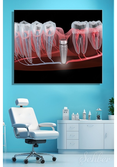 Dental İmplant Tıbbi 3d Çizim Yatay Kanvas Tablo Tekli Ağız Diş Sağlığı Dişçi Poliklinik Hastane 3497