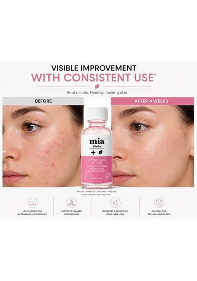 Sivilce Kurutucu Losyon Salisilik Asit & Kalamin 30ml