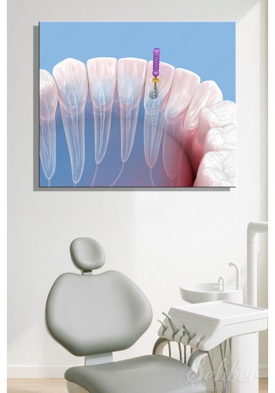 Endodontik Kök Kanal Tedavi Sürecinin 3d Tıbbi İllüstrasyonu Yatay Kanvas Tablo Tekli 3746 Çok Renkli