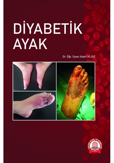 Diyabetik Ayak
