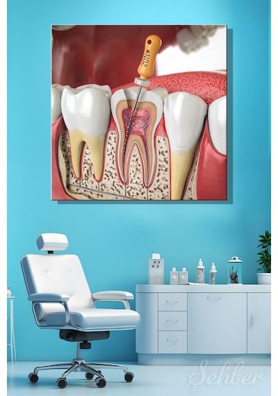 Endodontik Tedavi Kanal Tedavisi Prosedürü 3d Tıbbi İllüstrasyon Yatay Kanvas Tablo 3862 Çok Renkli