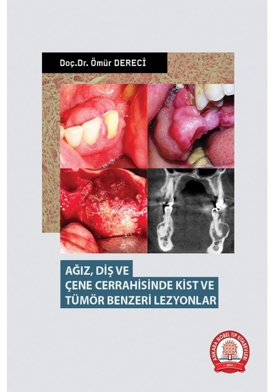 Ağız Diş Ve Çene Cerrahisinde Kist Ve Tümör Benzeri Lezyonlar