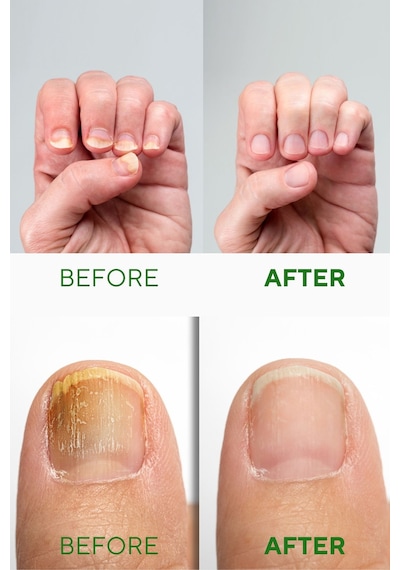 Ceelini El ve Ayak , Koku Tırnak Güçlendirici Çay Ağacı , Salisik Asit Özlü Serum 30 ml