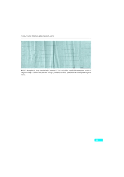 Normal Ve Patolojik Pediatrik Ekg Atlası
