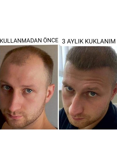 Saç Büyüme Serumu, Hair, 50 Ml, 10'lü Set - Hair