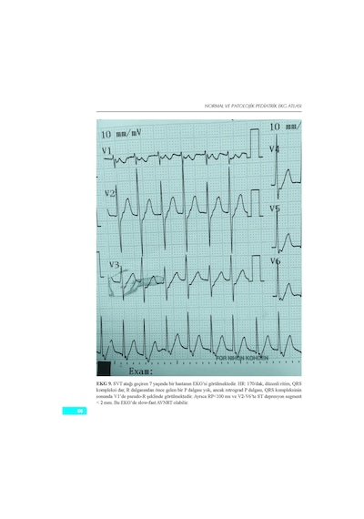 Normal Ve Patolojik Pediatrik Ekg Atlası