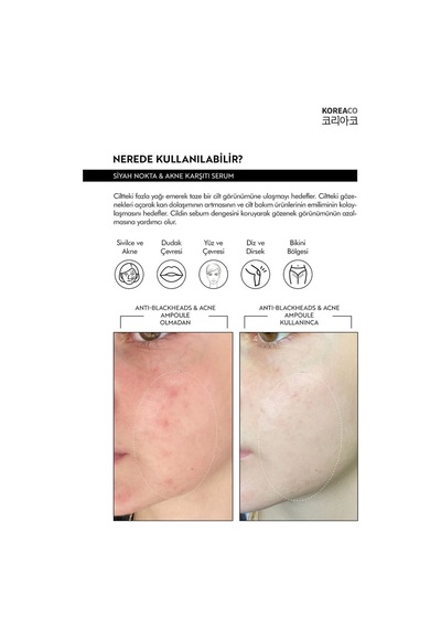 Koreaco Sivilce Blackheads Akne ve Siyah Nokta Karşıtı Süper Serum 50ml