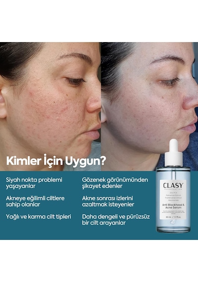 Niacinamide Yüz Serumu Gözenek Görünümünü Sıkılaştırmaya Ve Yağ Dengesini Desteklemeye Yardım