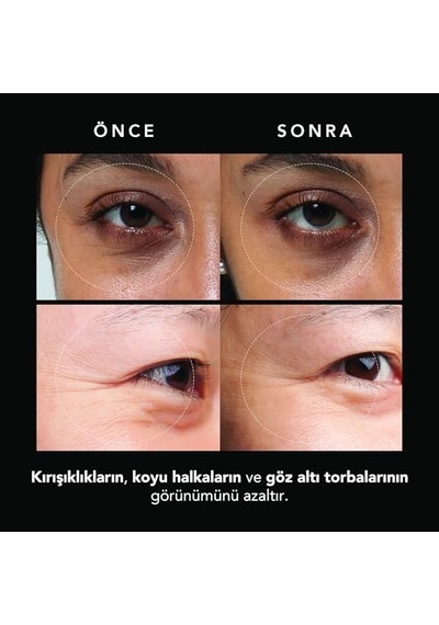 Mikroiğneli Kırışıklık Karşıtı Hyaluronik Asit Göz Altı Pedleri Göz Altı Şişlikleri Ve Morluklara Karşı