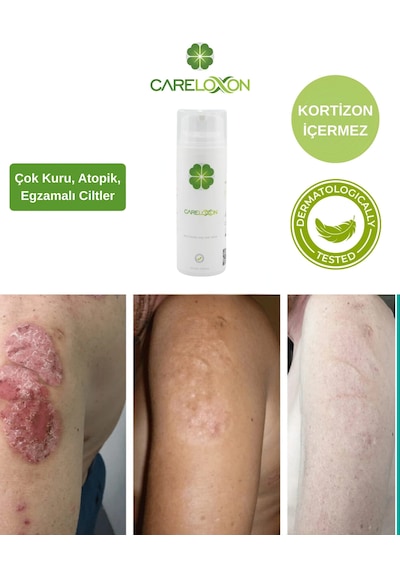 Careloxon Atopik ve Egzema Eğilimli Ciltler İçin Cilt Bakım Kremi 100 ML