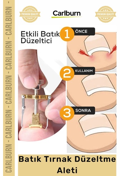 Özel Üretim Ayak Tırnağı Ağrısı Giderici Düzeltici Evde Güvenli Kolay Bakım Batık Tırnak