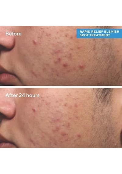 Murad Relief Spot Treatment - Lokal Sivilce Kurutucu Jel 1 Paket 1 X 15 Ml