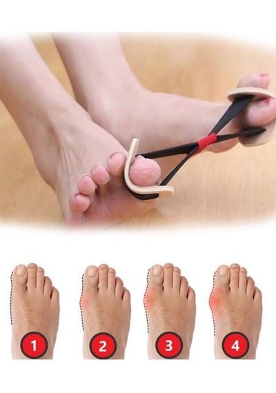 Ayak Başparmak Kemik Düzeltici Bunyon Hallux Vagus Egzersiz Lastiği