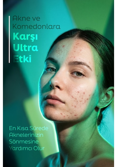 Aida Jia Salisilik Asit ve Glikolik Asit İçerikli Akne Komedon Siyah Nokta Karşıtı Serum 30 ML