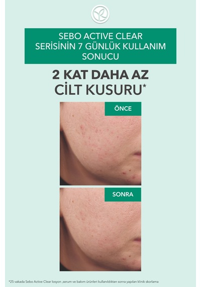 Yves Rocher Arındırıcı Gözenek Sıkılaştırıcı Tonik-süksinik Asit&çinko-sebo Active Clear Botanik Kompleks-150ml