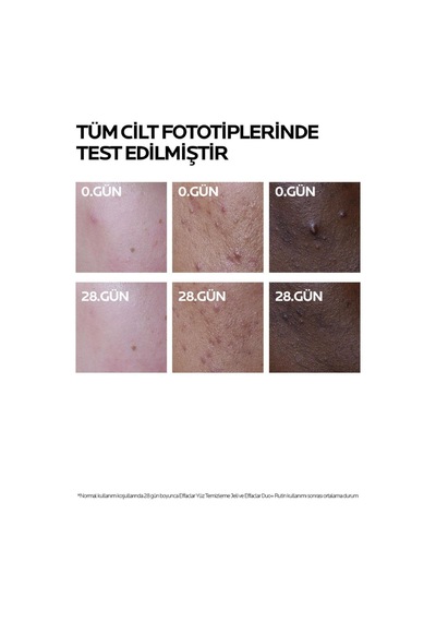 La Roche Posay Effaclar Duo + Cilt Kusuru Görünümü Karşıtı Akneye Eğilim Gösteren Ciltler İçin Bakım Kremi 40 Ml 2 Adet
