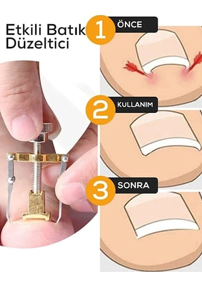 Batık Tırnak Çıkartıcı Orijinal Çelik Batan Tırnağı Düzeltme Aparatı Düzeltici Aleti Çıkarıcı Aparat