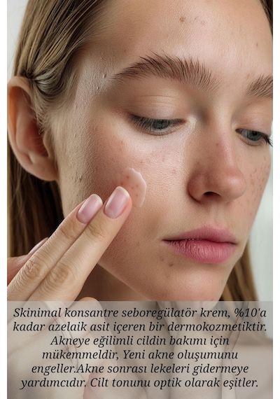 Skinimal Azelaik Asit İçeren Akne Karşıtı Sebum Azaltıcı ve Aydınlatıcı Krem 50 ML