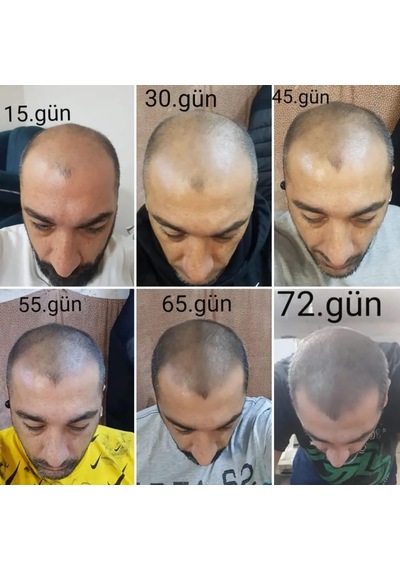 Saç Büyüme Serumu, Hair, 50 Ml, 10'lü Set - Hair