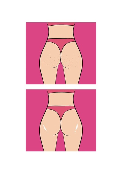 Buttoks Strawberry Cheeks Vücut Maskesi Çilek Ve Tavuk Derisi Görünümüne Elveda 2 Parça