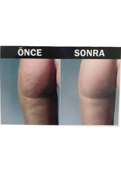 Hema Kadın Anti-cellulite Selülit  Masajlı Dikişsiz Paçalı Korse-beyaz Beyaz