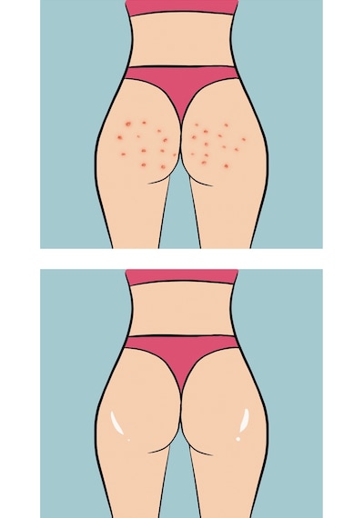 Skin Sensual Buttoks Buttne Vücut Maskesi | Vücut Sivilceleri ve Pürüzlere Karşı | 2 Parça